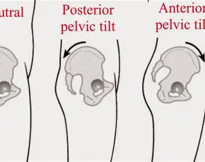 TOP 5 EXERCISES TO FIX PELVIS TILT