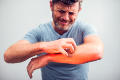 hacks for reducing itching